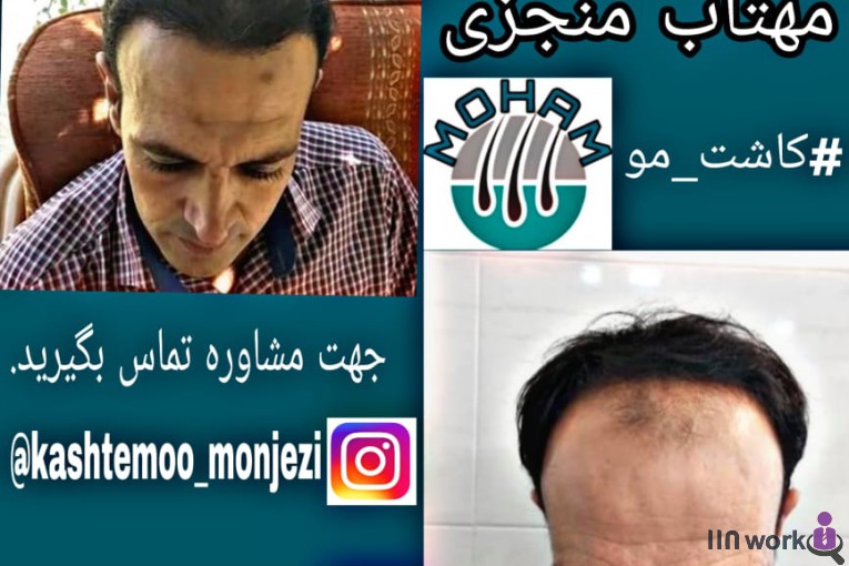 کاشت مو مهتاب منجزی در اهواز