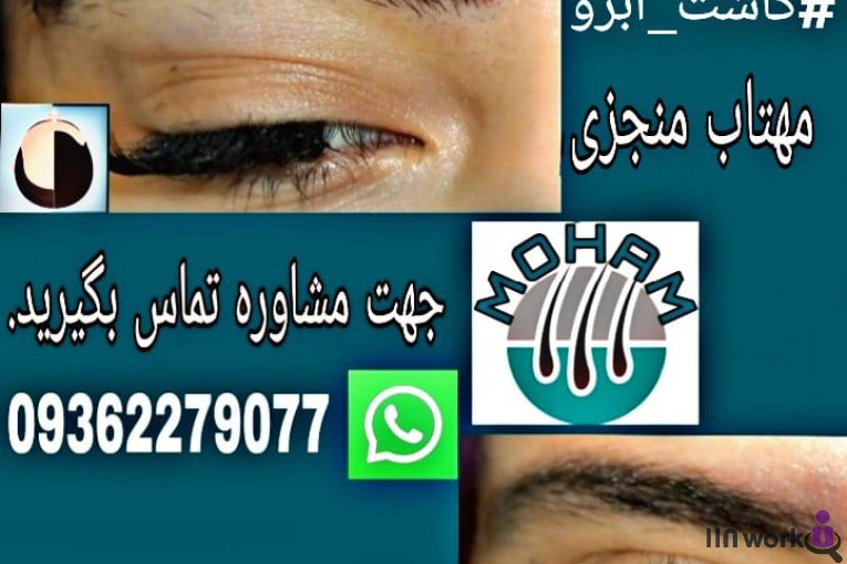 کاشت مو مهتاب منجزی در اهواز