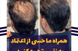 پروتز تخصصی مو سپه سالار در یزد
