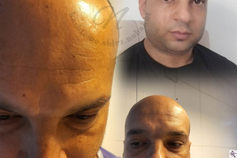 کاشت مو و ابرو تخصصی نوبخت در شیراز