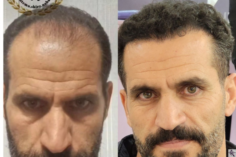 کاشت مو و ابرو تخصصی نوبخت در شیراز