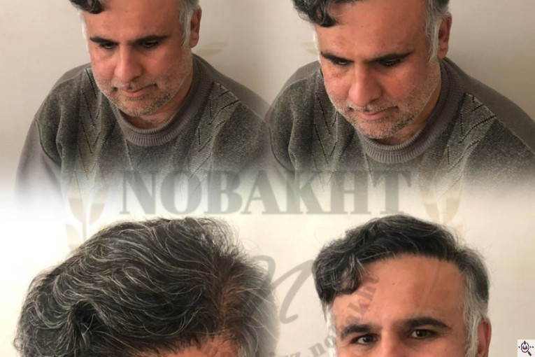 کاشت مو و ابرو تخصصی نوبخت در شیراز