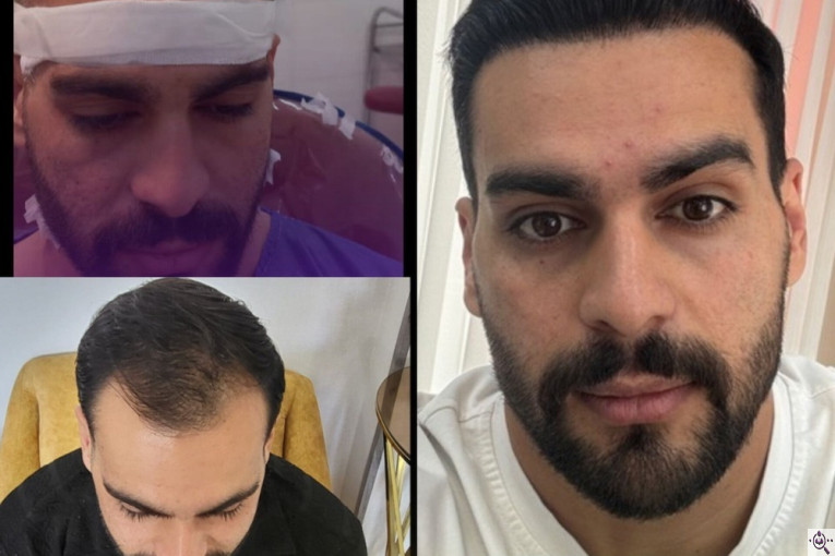کاشت مو و ابرو تخصصی نوبخت در شیراز