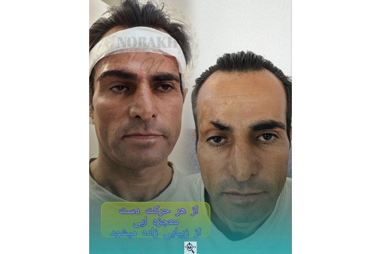 کاشت مو و ابرو تخصصی نوبخت در شیراز