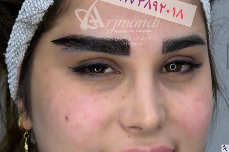 کاشت مو و ابرو زینب ارجمندی در شیراز