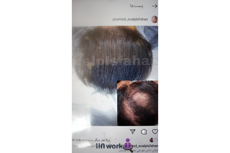 خدمات تخصصی میکرواسکالپ در اصفهان