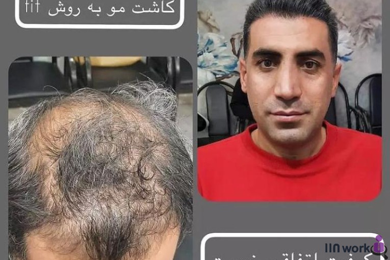 کاشت مو ساناز فولادی در شیراز