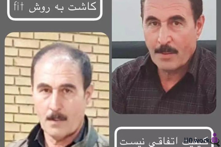 کاشت مو ساناز فولادی در شیراز