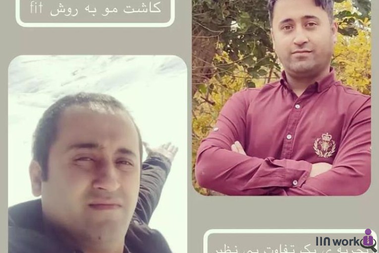 کاشت مو ساناز فولادی در شیراز
