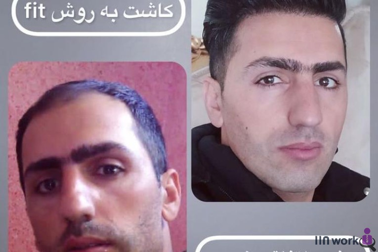 کاشت مو ساناز فولادی در شیراز