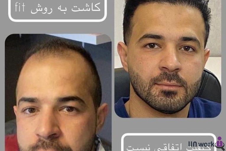 کاشت مو ساناز فولادی در شیراز