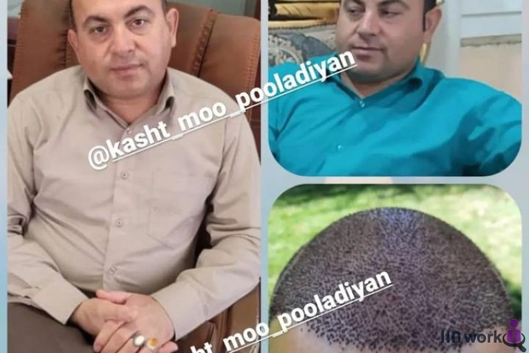 کاشت مو پولادیان در شیراز