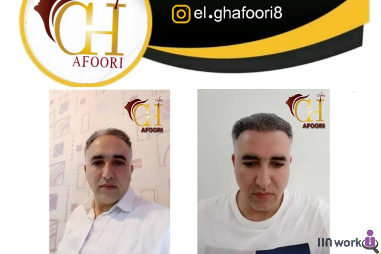 کاشت مو الهام غفوری در شیراز