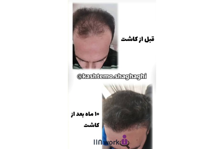 کاشت مو شقاقی در مشهد