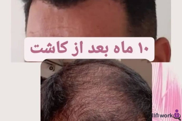 کاشت مو شقاقی در مشهد