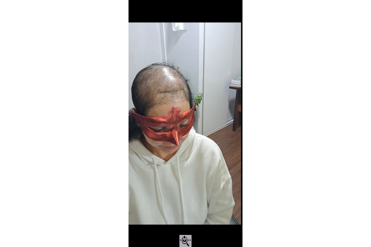 فروش پروتز مو رشت حمیده احمدی